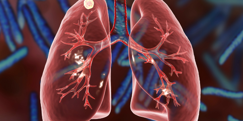 When to Worry About Lung Nodules